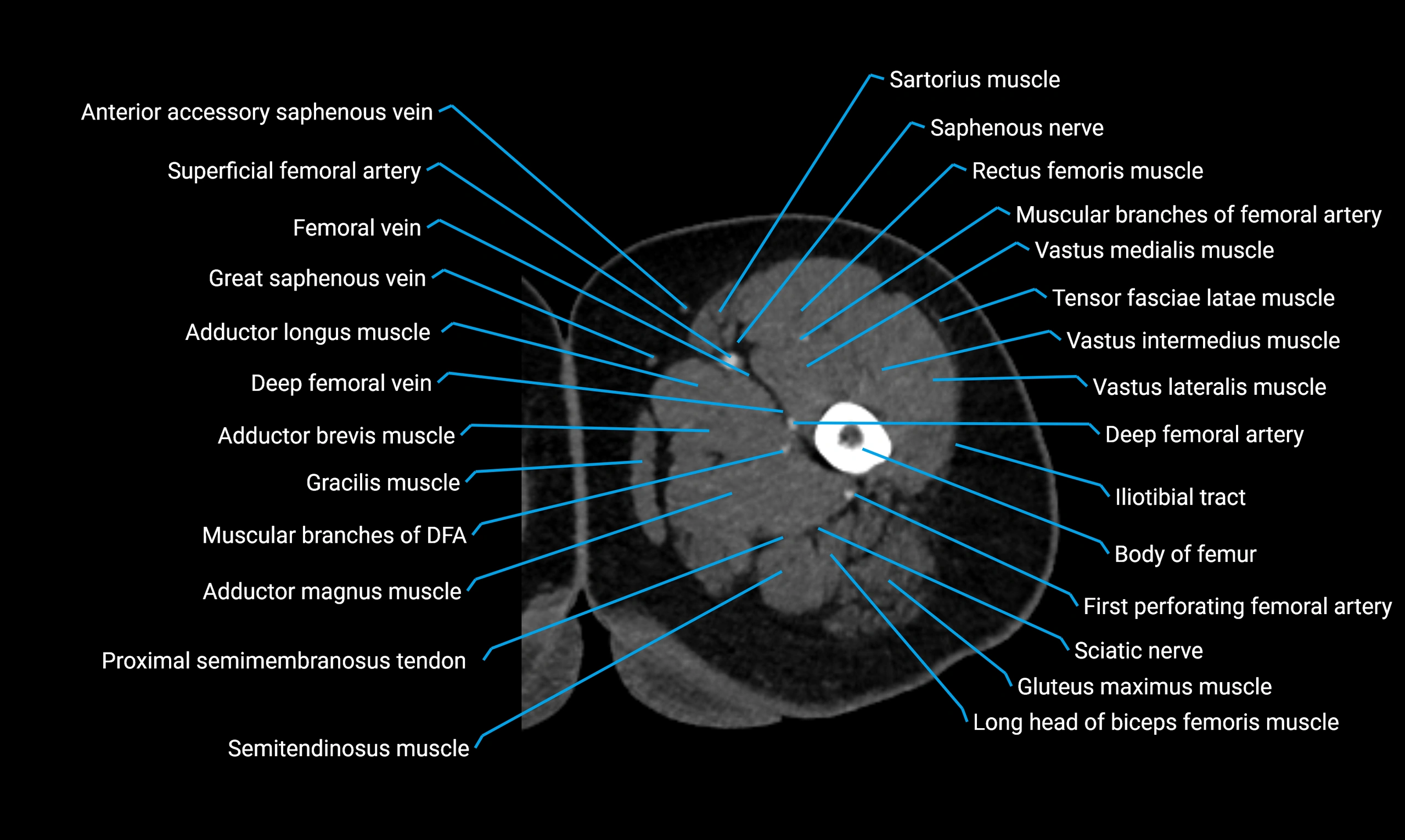 CT lower limb axial cross sectional anatomy labelled image 30 (2).webp